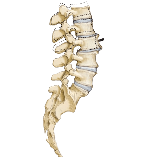 Spondylolisthesis