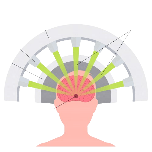 Stereotactic Radiosurgery