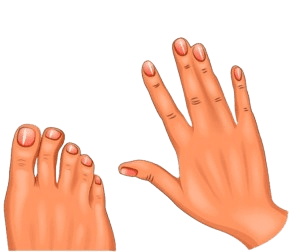 Syndactyly (Webbing)