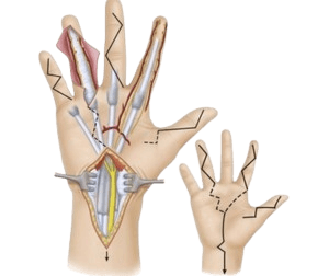 Synovectomy of Hand