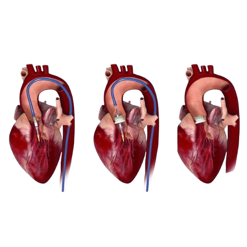 TAVI / TAVR (имплантация / замена транскатетерного аортального клапана)