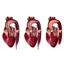 TAVI / TAVR (Transcatheter Aortic Valve Implantation / Replacement)