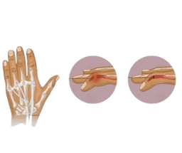 Tendon repair Surgery-Flexor Extensor