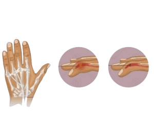Tendon repair Surgery-Flexor Extensor