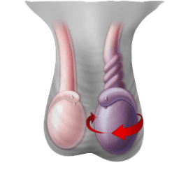 Testicular Torsion Surgery