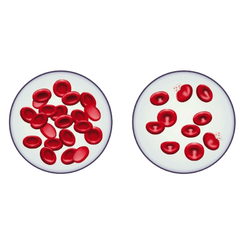 Thalassemia