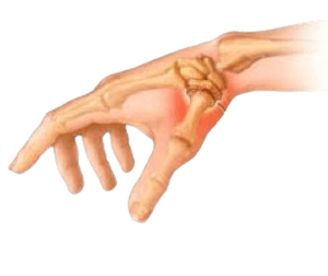 Thumb Arthroplasty