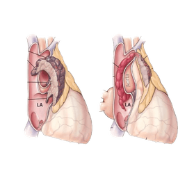 Thymoma and Thymic Carcinoma