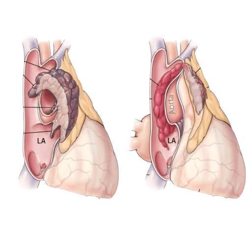 Thymoma and Thymic Carcinoma