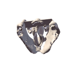 Thyroplasty