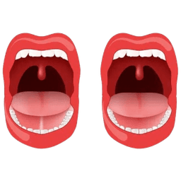 Tongue Tie- Ankyloglossia Surgery