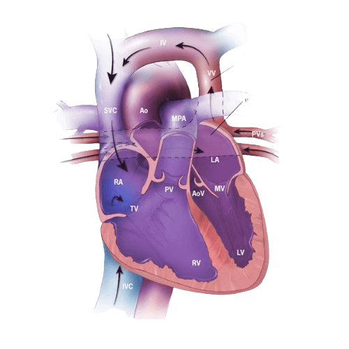 Total Anomalous Pulmonary Venous Return (TAPVR) Surgery