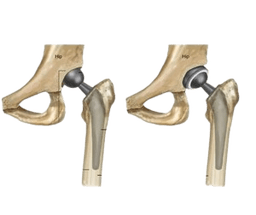 Total Hip Replacement