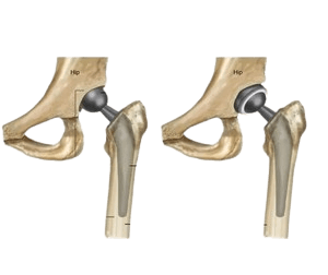 Total Hip Replacement
