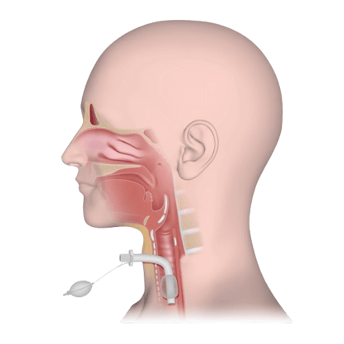 Tracheostomy