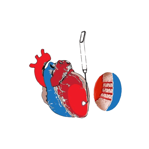 Transmyocardial Laser Revascularization (TMR)