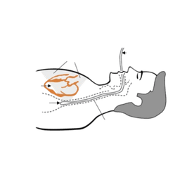 Transoesophageal Echocardiogram