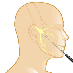 Trigeminal Neuralgia Surgery