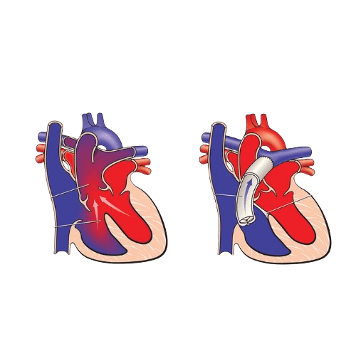 جراحة الشريان المشترك (Truncus Arteriosus)