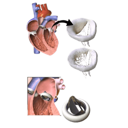 Valve Replacement Surgery