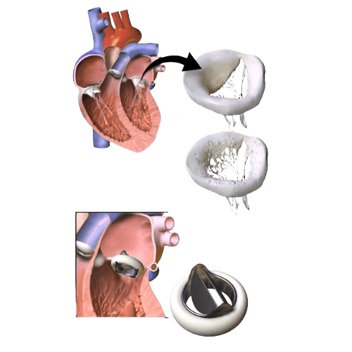 Valve Replacement Surgery