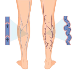 Varicose Veins