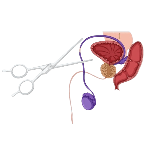 Vasectomy