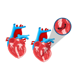 Ventricular Septal Defect (VSD) Closure Surgery in Adults