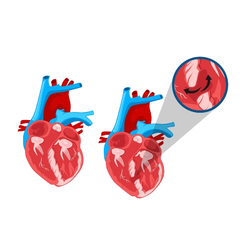 Ventricular Septal Defect (VSD) Closure Surgery in Adults