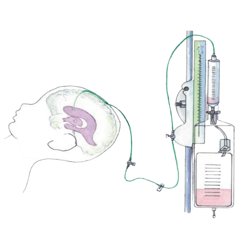 Ventriculostomy