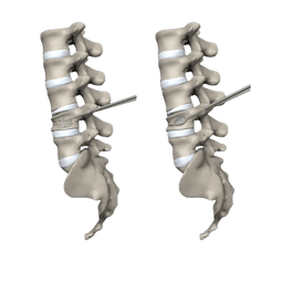 Vertebroplasty & Kyphoplasty