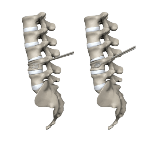 Vertebroplasty & Kyphoplasty