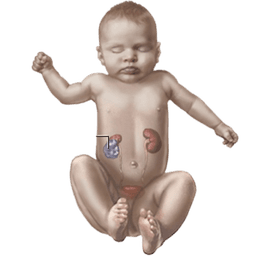 Wilms Tumor (Nephroblastoma)