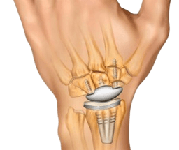 Wrist Joint Replacement (Wrist Arthroplasty)