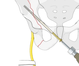 Acetabular Fixation