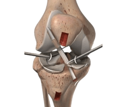 ACL Reconstruction Surgery