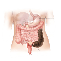 Adhesion Surgery