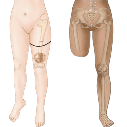 Amputation- Above Knee