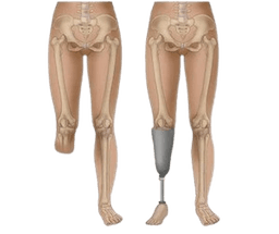 Amputation- Below Knee