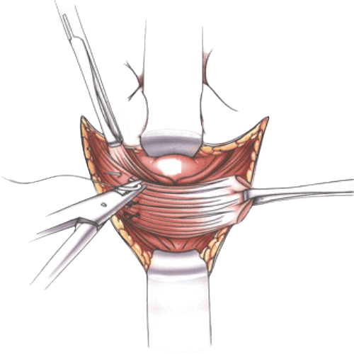 Anal Sfinkteroplastika