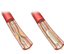 Angioplasty and Stent Placement