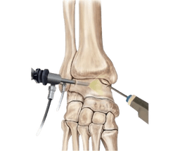 Ankle Arthroscopy