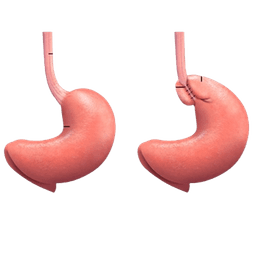 Anti Reflux Procedures