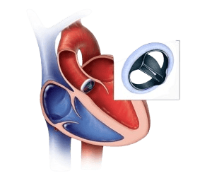 Aorta qopqog'ini almashtirish
