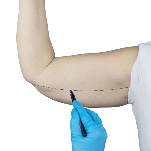 Qo‘lni ko‘tarish operatsiyasi (Braxioplastika)