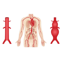 Arterial Aneurysms