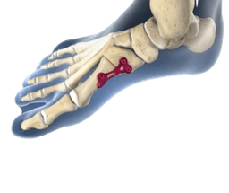 Arthrodesis