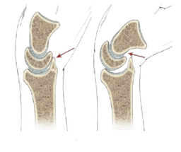 Arthrolysis