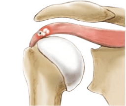 Arthroscopic Debridement Calcium Deposits