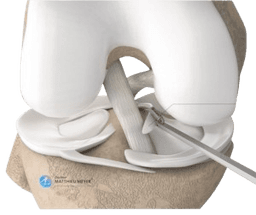 Arthroscopic Meniscectomy